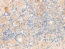 THNSL1 Antibody - Immunohistochemistry of paraffin-embedded Human liver cancer tissue  using THNSL1 Polyclonal Antibody at dilution of 1:70(×200)