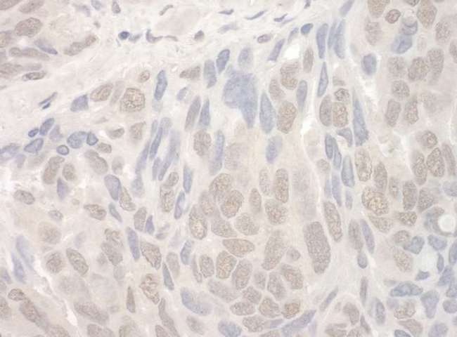 THOC2 Antibody - Detection of Human THOC2 by Immunohistochemistry. Sample: FFPE section of human ovarian carcinoma. Antibody: Affinity purified rabbit anti-THOC2 used at a dilution of 1:1000 (1 ug/mg).