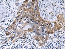 THOC3 Antibody - Immunohistochemistry of paraffin-embedded Human esophagus cancer tissue  using THOC3 Polyclonal Antibody at dilution of 1:50(×200)