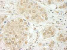 THOC5 Antibody - Detection of Human THOC5 by Immunohistochemistry. Sample: FFPE section of human breast carcinoma. Antibody: Affinity purified rabbit anti-THOC5 used at a dilution of 1:250.