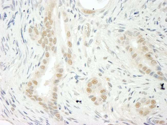 THOC5 Antibody - Detection of Human THOC5 by Immunohistochemistry. Sample: FFPE section of human stomach carcinoma. Antibody: Affinity purified rabbit anti-THOC5 used at a dilution of 1:250.