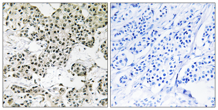 THOC5 Antibody - Immunohistochemistry analysis of paraffin-embedded human breast carcinoma tissue, using THOC5 Antibody. The picture on the right is blocked with the synthesized peptide.
