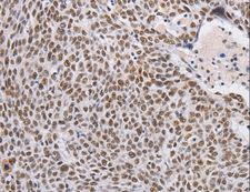THOC7 Antibody - Immunohistochemistry of paraffin-embedded Human lung cancer using THOC7 Polyclonal Antibody at dilution of 1:30.