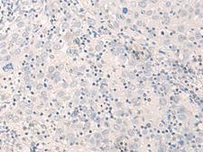 THOP1 / Thimet Oligopeptidase Antibody - Immunohistochemistry of paraffin-embedded Human cervical cancer tissue  using THOP1 Polyclonal Antibody at dilution of 1:35(×200)