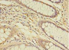 THRA / THR Alpha Antibody - Immunohistochemistry of paraffin-embedded human colon cancer using antibody at 1:100 dilution.  This image was taken for the unconjugated form of this product. Other forms have not been tested.