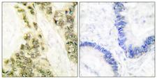THRA / THR Alpha Antibody - Immunohistochemistry analysis of paraffin-embedded human colon carcinoma tissue, using Thyroid Hormone Receptor alpha Antibody. The picture on the right is blocked with the synthesized peptide.