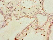 THRSP Antibody - Immunohistochemistry of paraffin-embedded human breast cancer at dilution 1:100