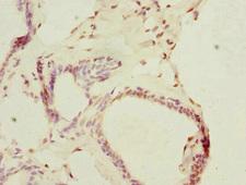 THRSP Antibody - Immunohistochemistry of paraffin-embedded human breast cancer at dilution 1:100