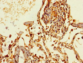 THRSP Antibody - Paraffin-embedding Immunohistochemistry using human lung cancer at dilution 1:100