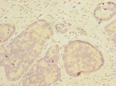 THTPA Antibody - Immunohistochemistry of paraffin-embedded human gastric cancer using antibody at dilution of 1:100.