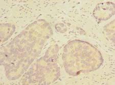 THTPA Antibody - Immunohistochemistry of paraffin-embedded human gastric cancer using antibody at dilution of 1:100.