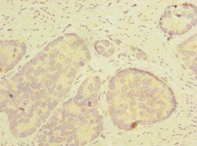 THTPA Antibody - Immunohistochemistry of paraffin-embedded human gastric cancer using THTPA Antibody at dilution of 1:100