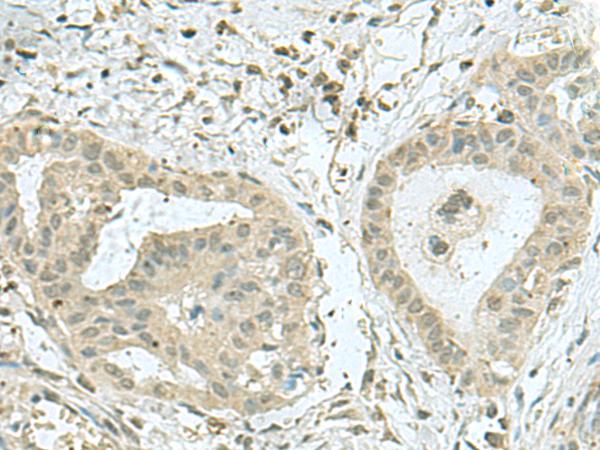THTPA Antibody - Immunohistochemistry of paraffin-embedded Human thyroid cancer tissue  using THTPA Polyclonal Antibody at dilution of 1:70(×200)