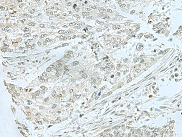 THTPA Antibody - Immunohistochemistry of paraffin-embedded Human lung cancer tissue  using THTPA Polyclonal Antibody at dilution of 1:70(×200)