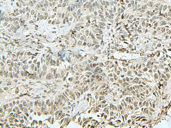 THTPA Antibody - Immunohistochemistry of paraffin-embedded Human ovarian cancer tissue  using THTPA Polyclonal Antibody at dilution of 1:90(×200)
