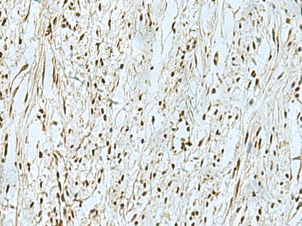 THTPA Antibody - Immunohistochemistry of paraffin-embedded Human breast cancer tissue  using THTPA Polyclonal Antibody at dilution of 1:90(×200)