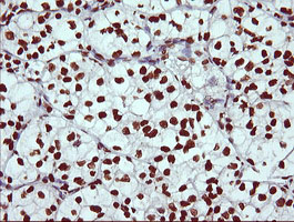 THUMPD1 Antibody - IHC of paraffin-embedded Carcinoma of Human kidney tissue using anti-THUMPD1 mouse monoclonal antibody.