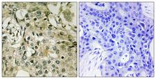 Thymidylate Kinase Antibody - Immunohistochemistry analysis of paraffin-embedded human breast carcinoma tissue, using DTYMK Antibody. The picture on the right is blocked with the synthesized peptide.