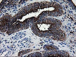 Thymidylate Kinase Antibody - IHC of paraffin-embedded Adenocarcinoma of Human endometrium tissue using anti-DTYMK mouse monoclonal antibody.