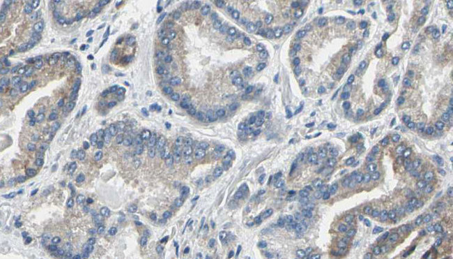 Thymidylate Kinase Antibody - 1:100 staining human prostate tissue by IHC-P. The sample was formaldehyde fixed and a heat mediated antigen retrieval step in citrate buffer was performed. The sample was then blocked and incubated with the antibody for 1.5 hours at 22°C. An HRP conjugated goat anti-rabbit antibody was used as the secondary.