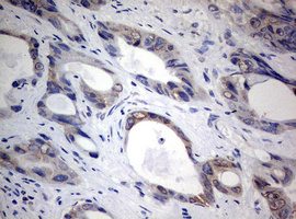 TIA-1 Antibody - IHC of paraffin-embedded Adenocarcinoma of Human colon tissue using anti-TIA1 mouse monoclonal antibody.