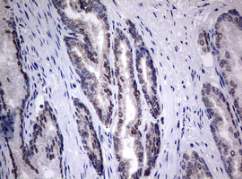 TIA-1 Antibody - IHC of paraffin-embedded Carcinoma of Human prostate tissue using anti-TIA1 mouse monoclonal antibody.