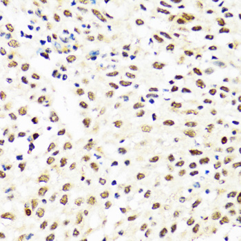 TIA-1 Antibody - Immunohistochemistry of paraffin-embedded human lung cancer tissue.