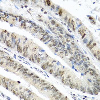 TIA-1 Antibody - Immunohistochemistry of paraffin-embedded human colon carcinoma using TIA1 antibody at dilution of 1:100 (40x lens).