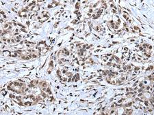 TIA-1 Antibody - Immunohistochemistry of paraffin-embedded Human gastric cancer tissue  using TIA1 Polyclonal Antibody at dilution of 1:30(×200)