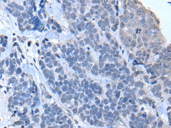 TIA-1 Antibody - Immunohistochemistry of paraffin-embedded Human thyroid cancer tissue  using TIA1 Polyclonal Antibody at dilution of 1:30(×200)