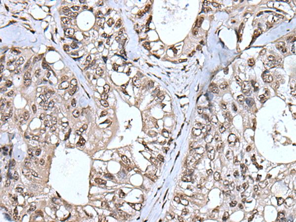 TIA-1 Antibody - Immunohistochemistry of paraffin-embedded Human colorectal cancer tissue  using TIA1 Polyclonal Antibody at dilution of 1:55(×200)
