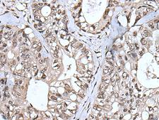TIA-1 Antibody - Immunohistochemistry of paraffin-embedded Human colorectal cancer tissue  using TIA1 Polyclonal Antibody at dilution of 1:55(×200)