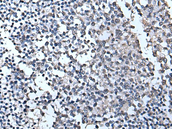 TIA-1 Antibody - Immunohistochemistry of paraffin-embedded Human tonsil tissue  using TIA1 Polyclonal Antibody at dilution of 1:55(×200)