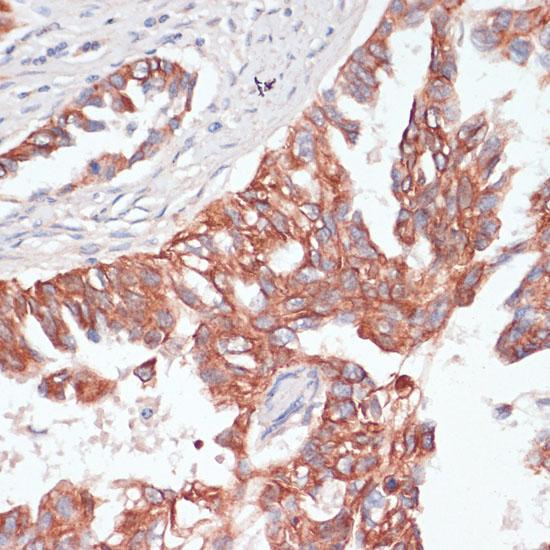 TIAM1 Antibody - Immunohistochemistry of paraffin-embedded Human lung cancer using TIAM1 Polyclonal Antibody at dilution of 1:100 (40x lens).
