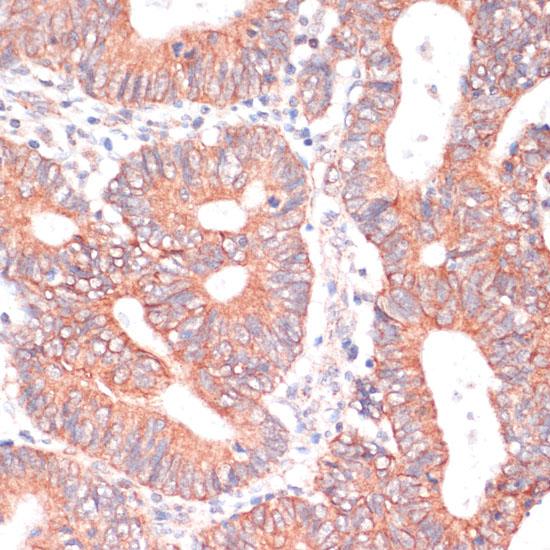 TIAM1 Antibody - Immunohistochemistry of paraffin-embedded Human colon carcinoma using TIAM1 Polyclonal Antibody at dilution of 1:100 (40x lens).