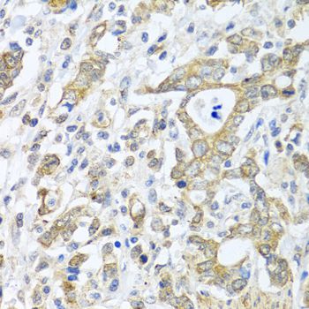 TICAM1 / TRIF Antibody - Immunohistochemistry of paraffin-embedded human gastric cancer using TICAM1 antibody at dilution of 1:100 (40x lens).