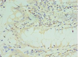 TICAM2 / TRAM Antibody - Immunohistochemistry of paraffin-embedded human colon cancer cancer using antibody at 1:100 dilution.