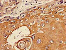 TIE1 / TIE Antibody - Immunohistochemistry image of paraffin-embedded human ovarian cancer at a dilution of 1:100