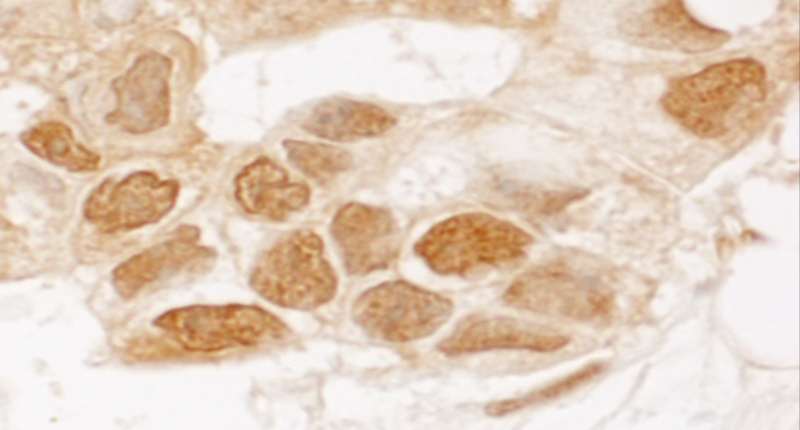 TIGAR Antibody - Detection of Human TIGAR by Immunohistochemistry. Sample: FFPE section of human prostate carcinoma. Antibody: Affinity purified rabbit anti-TIGAR used at a dilution of 1:1000 (1 ug/ml). Detection: DAB.