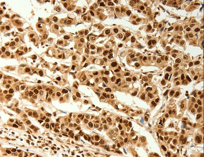 TIGAR Antibody - Immunohistochemistry of paraffin-embedded Human breast cancer using C12orf5 Polyclonal Antibody at dilution of 1:80.