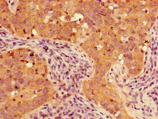 TIGAR Antibody - Immunohistochemistry of paraffin-embedded human pancreatic cancer using TIGAR Antibody at dilution of 1:100