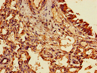 TIGAR Antibody - Immunohistochemistry of paraffin-embedded human lung cancer using TIGAR Antibody at dilution of 1:100