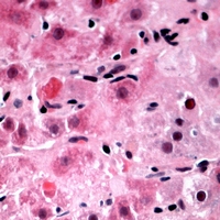 TIGD3 Antibody - Immunohistochemical analysis of TIGD3 staining in human liver cancer formalin fixed paraffin embedded tissue section. The section was pre-treated using heat mediated antigen retrieval with sodium citrate buffer (pH 6.0). The section was then incubated with the antibody at room temperature and detected with HRP and AEC as chromogen. The section was then counterstained with hematoxylin and mounted with DPX.