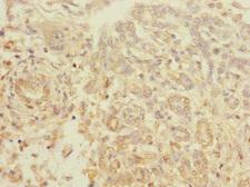 TIGD7 Antibody - Immunohistochemistry of paraffin-embedded human pancreatic cancer using TIGD7 Antibody at dilution of 1:100