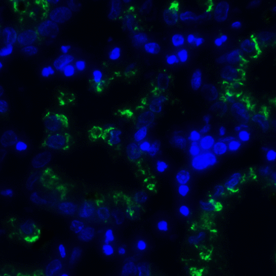 TIGIT Antibody - Immunofluorescence of TIGIT in human stomach carcinoma tissue using TIGIT Antibody at 5 ug/ml. Green: TIGIT Antibody [10B1] Blue: DAPI staining