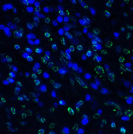 TIGIT Antibody - Immunofluorescence of TIGIT in human stomach carcinoma tissue using TIGIT Antibody at 5 ug/ml. Green: TIGIT Antibody [4A10] Blue: DAPI staining