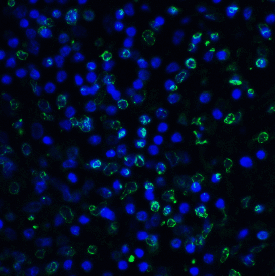 TIGIT Antibody - Immunofluorescence of TIGIT in human stomach carcinoma tissue using TIGIT Antibody at 5 ug/ml. Green: TIGIT Antibody [4A11] Blue: DAPI staining