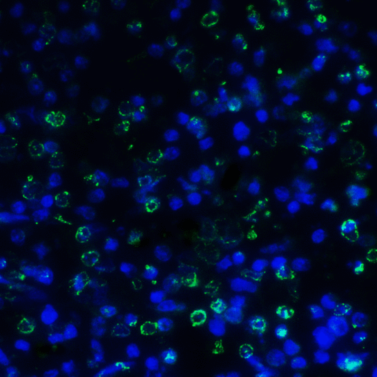 TIGIT Antibody - Immunofluorescence of TIGIT in human stomach carcinoma tissue using TIGIT Antibody at 5 ug/ml. Green: TIGIT Antibody [4A12] Blue: DAPI staining