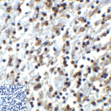 TIGIT Antibody - Immunohistochemistry of TIGIT in human stomach carcinoma tissue using TIGIT Antibody and control mouse IgG (corner box) at 2 ug/ml.