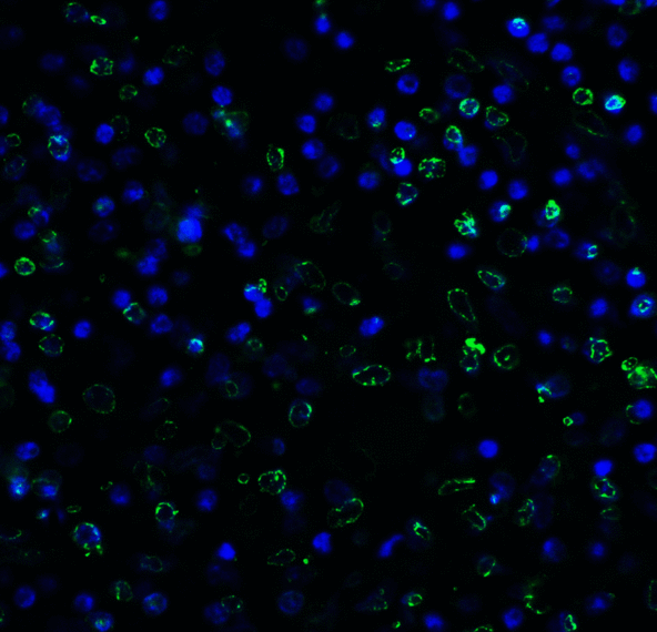 TIGIT Antibody - Immunofluorescence of TIGIT in human stomach carcinoma tissue using TIGIT Antibody at 5 ug/ml. Green: TIGIT Antibody [7E5] Blue: DAPI staining